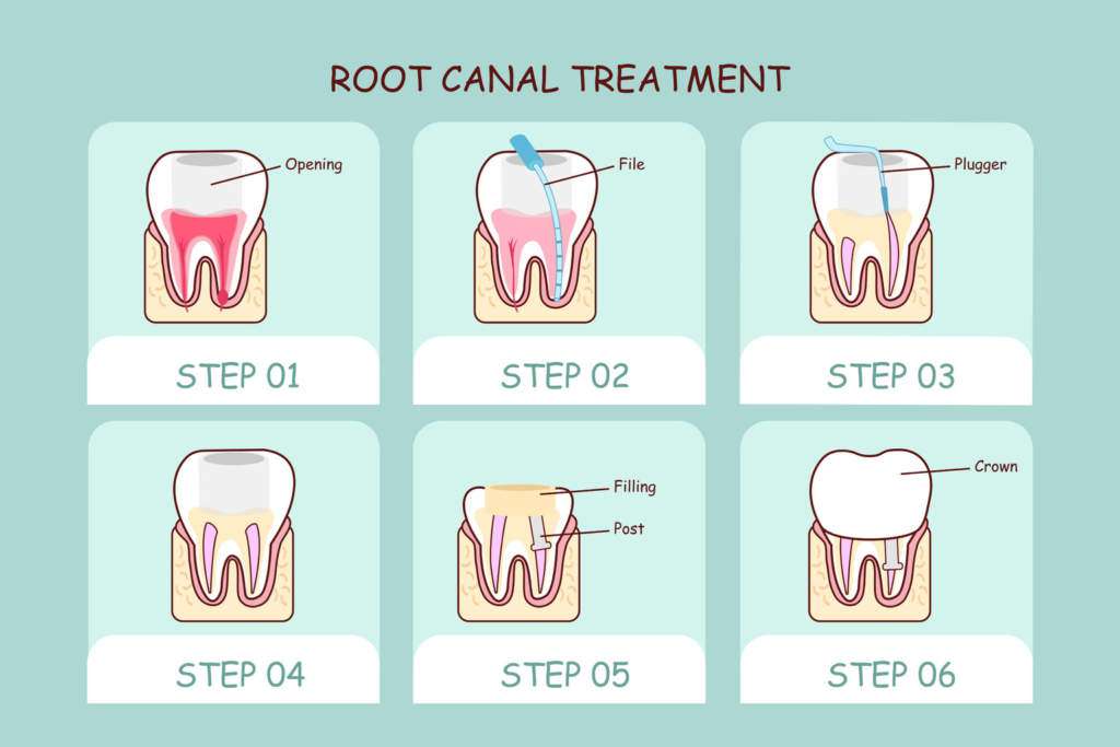 Лечение корневых каналов, или эндодонтия, часто является единственным способом спасти зуб