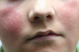 Синдром пощечины щеки (пятое заболевание) часто встречается у детей и должен пройти самостоятельно в течение 3 недель