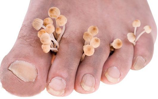 Нередко у людей возникает вопрос, как лечить грибок на ногах